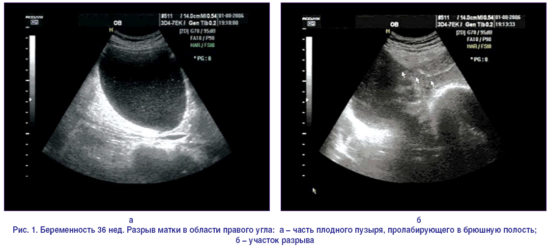 Узи после родов. УЗИ рубца на матке при беременности. Диагностика рахрыва м атки. Диагностик разрыва матик.