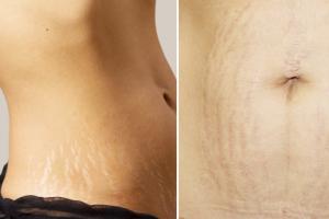 How to remove stretch marks on the stomach: home and salon methods, photos, videos